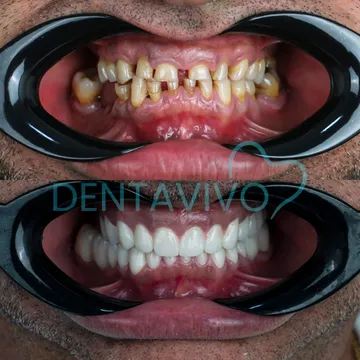 Before and after dental treatment result 2