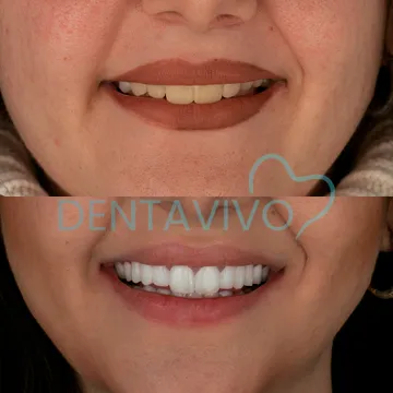 Before and after dental treatment result 4